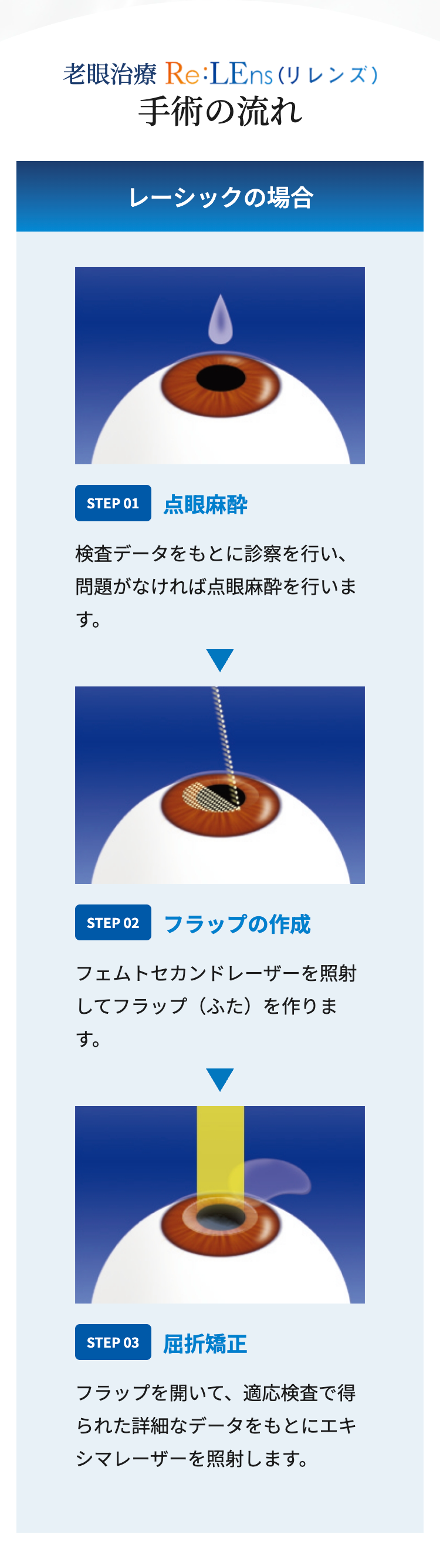 老眼治療 Re:LEns (リレンズ)
手術の流れ
レーシックの場合
STEP 01 点眼麻醉
検査データをもとに診察を行い、
問題がなければ点眼麻酔を行いま
す。
STEP 02 フラップの作成
フェムトセカンドレーザーを照射
してフラップ(ふた)を作りま
す。
STEP 03 屈折矯正
フラップを開いて、 適応検査で得
られた詳細なデータをもとにエキ
シマレーザーを照射します。