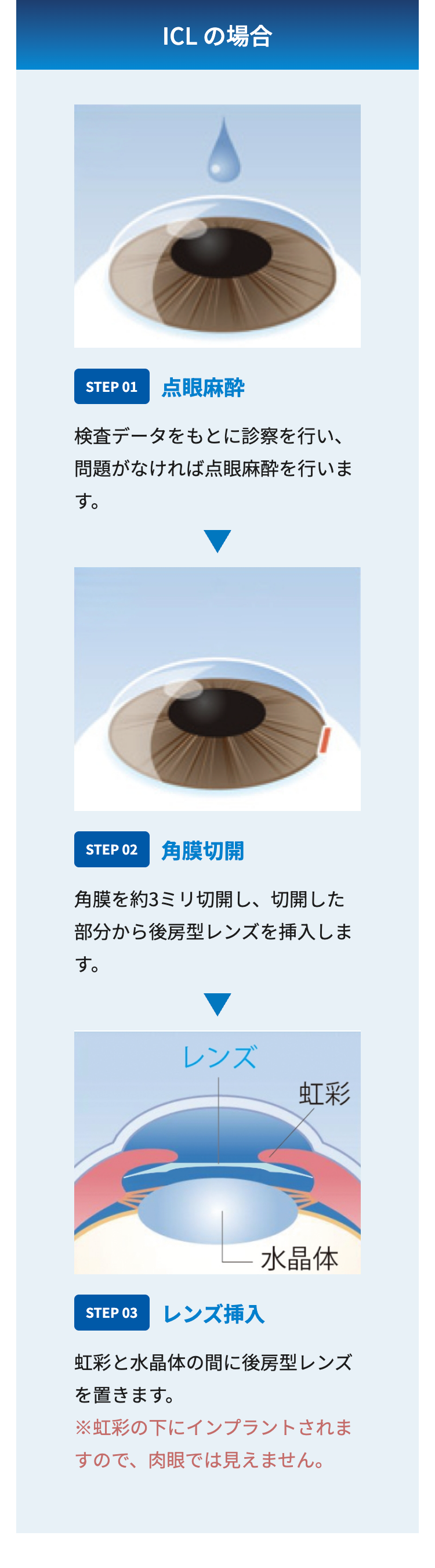 ICL の場合
STEP 01 点眼麻醉
検査データをもとに診察を行い、
問題がなければ点眼麻酔を行いま
す。
STEP 02 角膜切開
角膜を約3ミリ切開し、 切開した
部分から後房型レンズを挿入しま
す。
レンズ
虹彩
STEP 03 レンズ挿入
水晶体
虹彩と水晶体の間に後房型レンズ
を置きます。
※虹彩の下にインプラントされま
すので、肉眼では見えません。