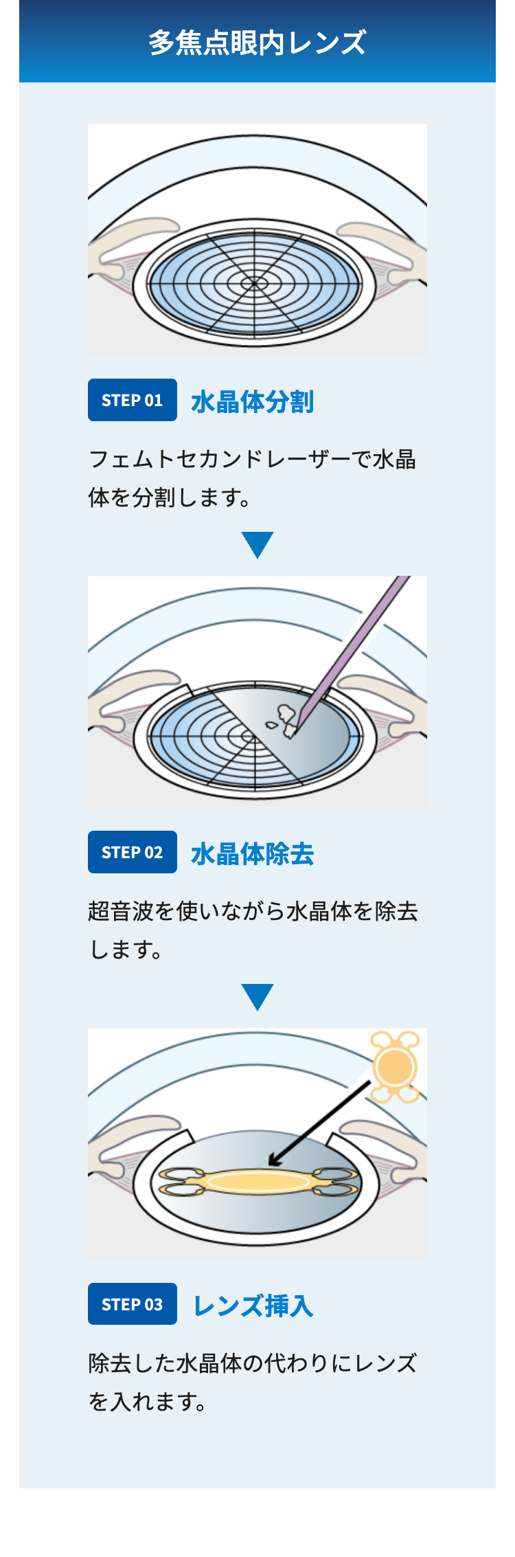 多焦点眼内レンズ
STEP 01 水晶体分割
フェムトセカンドレーザーで水晶
体を分割します。
STEP 02 水晶体除去
超音波を使いながら水晶体を除去
します。
STEP 03 レンズ挿入
除去した水晶体の代わりにレンズ
を入れます。