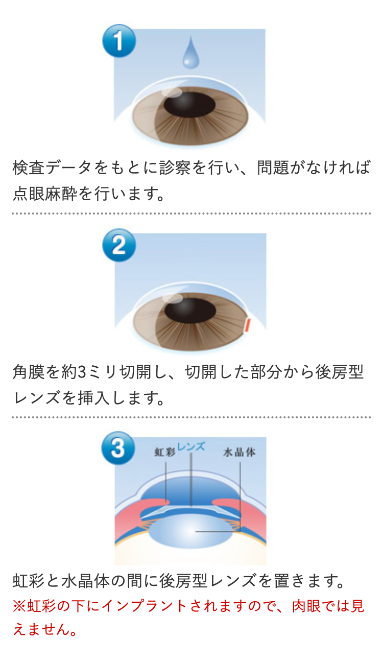 1
検査データをもとに診察を行い、 問題がなければ
点眼麻酔を行います。
2
角膜を約3ミリ切開し、切開した部分から後房型
レンズを挿入します。
3
虹彩レンズ
水晶体
虹彩と水晶体の間に後房型レンズを置きます。
※虹彩の下にインプラントされますので、肉眼では見
えません。
